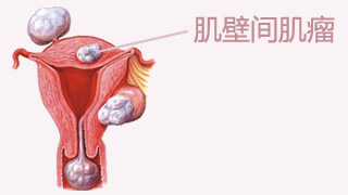 输卵管宫角植入术