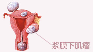 输卵管吻合术