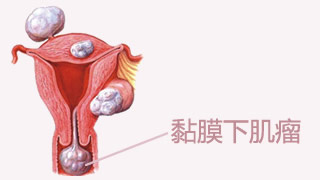 输卵管开口整形术